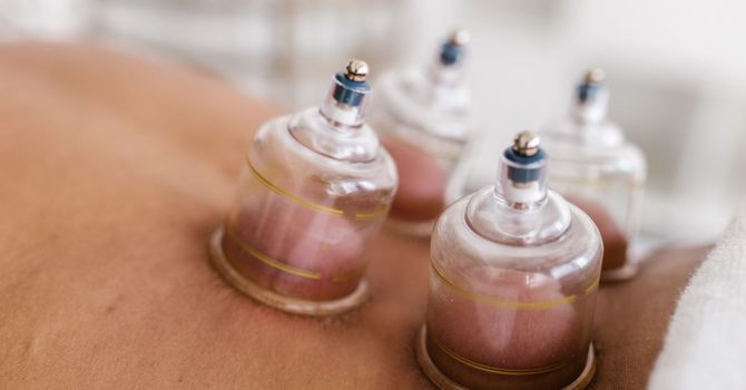Is Cupping Good for Back Pain? Evidence, Benefits & How It Works